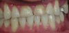 Figure 2  Pathological occlusal tooth wear. Note the severe incisal wear and shortening of the central incisors.