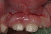 Figure 4  Chronic gingival enlargement of unknown origin in an 8-year-old girl. Buccal view.