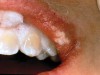 Figure 1  Soft-tissue chemical burns near the left commissure of the mouth and along the free gingival margin due to exposure to the whitening agent.