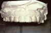 Figure 6  Proper adaptation and trimming of a whitening tray on a maxillary cast. Tray showing both the buccal and lingual aspects scalloped.